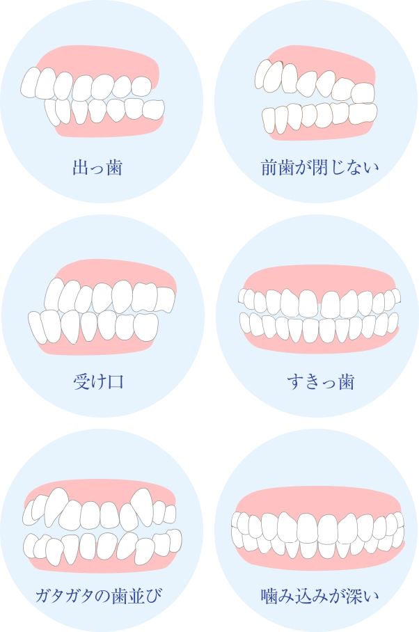 歯並びのイメージ